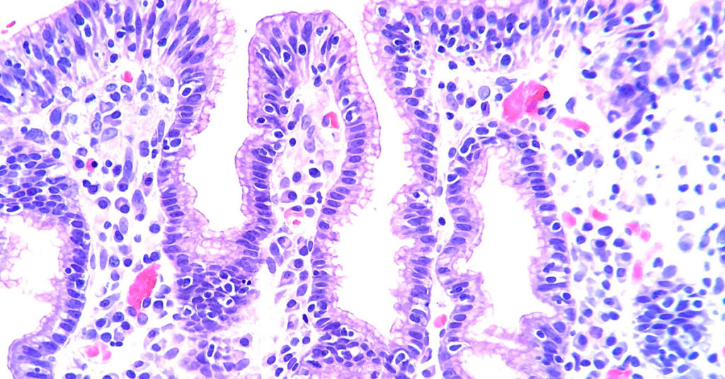 Celiac