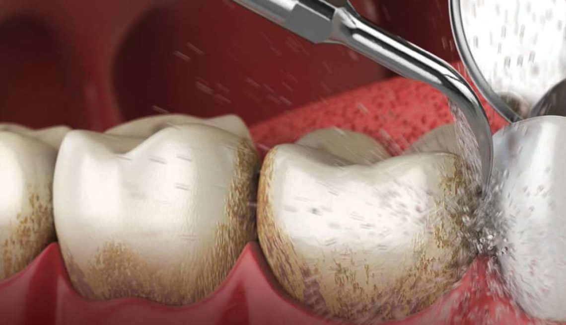 Ultrasonic Instrumentation Technique for First Molar Teeth Dimensions