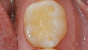 close up of tooth