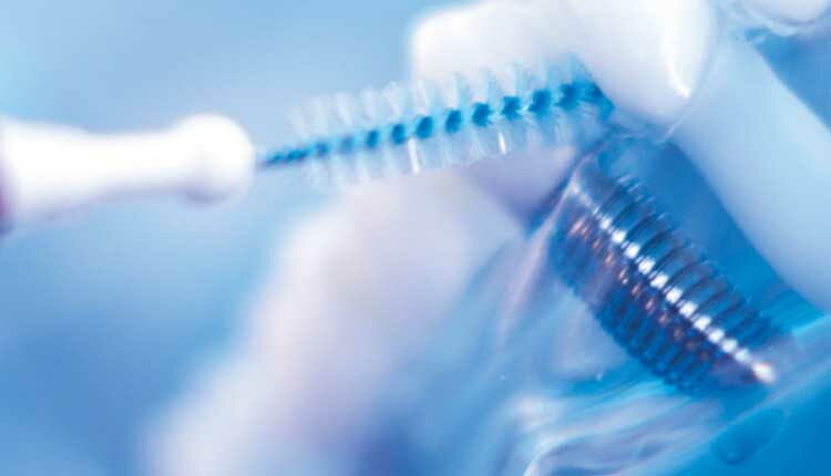 dental implant cleaning